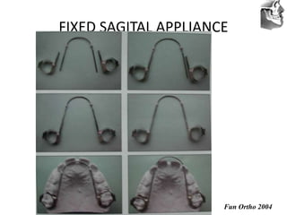 VT’s
FIXED SAGITAL APPLIANCE
Fun Ortho 2004
 