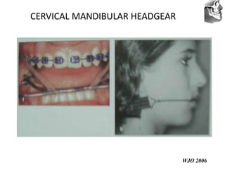 VT’s
CERVICAL MANDIBULAR HEADGEAR
WJO 2006
 