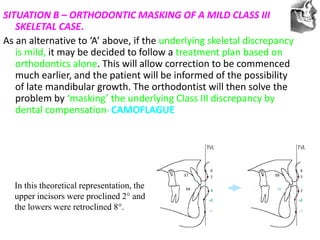 VT’s
SITUATION B – ORTHODONTIC MASKING OF A MILD CLASS III
SKELETAL CASE.
As an alternative to ‘A’ above, if the underlying skeletal discrepancy
is mild, it may be decided to follow a treatment plan based on
orthodontics alone. This will allow correction to be commenced
much earlier, and the patient will be informed of the possibility
of late mandibular growth. The orthodontist will then solve the
problem by ‘masking’ the underlying Class III discrepancy by
dental compensation- CAMOFLAGUE
In this theoretical representation, the
upper incisors were proclined 2° and
the lowers were retroclined 8°.
 