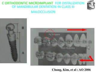 VT’s
C ORTHODONTIC MICROIMPLANT FOR DISTALIZATION
OF MANDIBULAR DENTATION IN CLASS III
MALOCCLUSION
Chung, Kim, et al : AO 2006
 