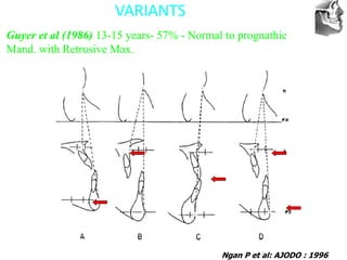 VT’s
VARIANTS
Ngan P et al: AJODO : 1996
Guyer et al (1986) 13-15 years- 57% - Normal to prognathic
Mand. with Retrusive Max.
 