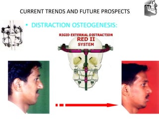 VT’s
CURRENT TRENDS AND FUTURE PROSPECTS
• DISTRACTION OSTEOGENESIS:
 