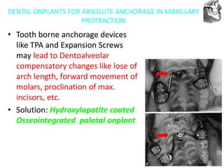 VT’s
DENTAL ONPLANTS FOR ABSOLUTE ANCHORAGE IN MAXILLARY
PROTRACTION
• Tooth borne anchorage devices
like TPA and Expansion Screws
may lead to Dentoalveolar
compensatory changes like lose of
arch length, forward movement of
molars, proclination of max.
incisors, etc.
• Solution: Hydroxylapatite coated
Osseointegrated palatal onplant
 