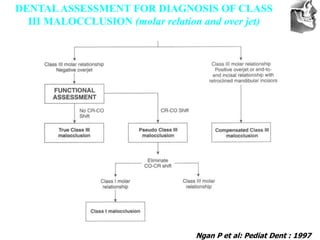 VT’s
DENTAL ASSESSMENT FOR DIAGNOSIS OF CLASS
III MALOCCLUSION (molar relation and over jet)
Ngan P et al: Pediat Dent : 1997
 