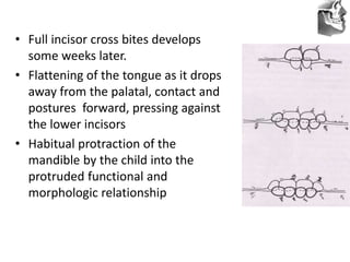 VT’s
• Full incisor cross bites develops
some weeks later.
• Flattening of the tongue as it drops
away from the palatal, contact and
postures forward, pressing against
the lower incisors
• Habitual protraction of the
mandible by the child into the
protruded functional and
morphologic relationship
 