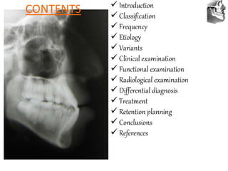 VT’s
CONTENTS  Introduction
 Classification
 Frequency
 Etiology
 Variants
 Clinical examination
 Functional examination
 Radiological examination
 Differential diagnosis
 Treatment
 Retention planning
 Conclusions
 References
 