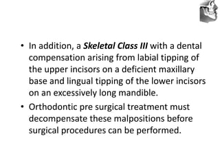 VT’s
• In addition, a Skeletal Class III with a dental
compensation arising from labial tipping of
the upper incisors on a deficient maxillary
base and lingual tipping of the lower incisors
on an excessively long mandible.
• Orthodontic pre surgical treatment must
decompensate these malpositions before
surgical procedures can be performed.
 