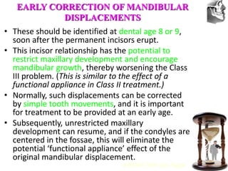 VT’s
• These should be identified at dental age 8 or 9,
soon after the permanent incisors erupt.
• This incisor relationship has the potential to
restrict maxillary development and encourage
mandibular growth, thereby worsening the Class
III problem. (This is similar to the effect of a
functional appliance in Class II treatment.)
• Normally, such displacements can be corrected
by simple tooth movements, and it is important
for treatment to be provided at an early age.
• Subsequently, unrestricted maxillary
development can resume, and if the condyles are
centered in the fossae, this will eliminate the
potential ‘functional appliance’ effect of the
original mandibular displacement.
EARLY CORRECTION OF MANDIBULAR
DISPLACEMENTS
AJODO 2006 Apr Suppl
 