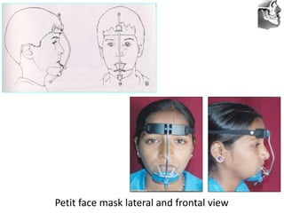 VT’s
Petit face mask lateral and frontal view
 