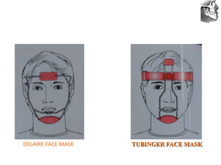 VT’s
DELAIRE FACE MASK TUBINGER FACE MASK
 