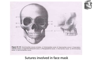 VT’s
Sutures involved in face mask
 
