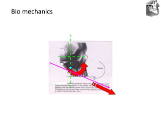 VT’s
Bio mechanics
 