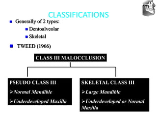 VT’s
CLASSIFICATIONS
 Generally of 2 types:
 Dentoalveolar
 Skeletal
 TWEED (1966)
PSEUDO CLASS III
Normal Mandible
Underdeveloped Maxilla
SKELETAL CLASS III
Large Mandible
Underdeveloped or Normal
Maxilla
CLASS III MALOCCLUSION
 