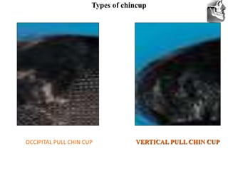 VT’s
OCCIPITAL PULL CHIN CUP VERTICAL PULL CHIN CUP
Types of chincup
 