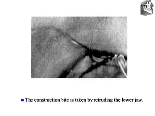 VT’s
 The construction bite is taken by retruding the lower jaw.
 