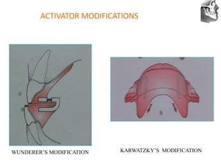 VT’s
ACTIVATOR MODIFICATIONS
KARWATZKY’S MODIFICATION
WUNDERER’S MODIFICATION
 