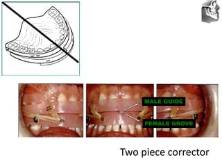 VT’s
Two piece corrector
MALE GUIDE
FEMALE GROVE
 