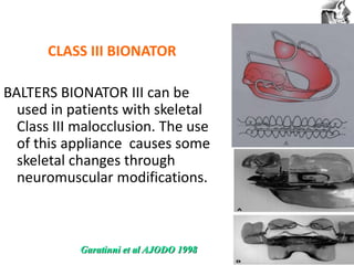 VT’s
CLASS III BIONATOR
BALTERS BIONATOR III can be
used in patients with skeletal
Class III malocclusion. The use
of this appliance causes some
skeletal changes through
neuromuscular modifications.
Garatinni et al AJODO 1998
 