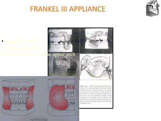 VT’s
FRANKEL III APPLIANCE
• Upper lip pads
• Lower labial bow
• Protrusion bow in the upper arch
 