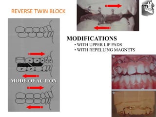 VT’s
REVERSE TWIN BLOCK
MODE OFACTION
MODIFICATIONS
• WITH UPPER LIP PADS
• WITH REPELLING MAGNETS
 