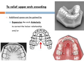 To relief upper arch crowding


   Additional space can be gained by

       Expansion the arch Anteriorly
        to co...