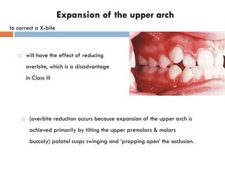 Expansion of the upper arch
to correct a X-bite



          will have the effect of reducing
           overbite, which ...