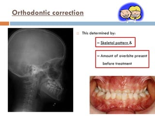 Orthodontic correction

                      This determined by:

                               – Skeletal pattern &


...