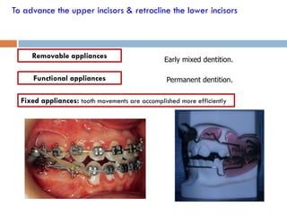 To advance the upper incisors & retrocline the lower incisors



     Removable appliances                       Early mix...