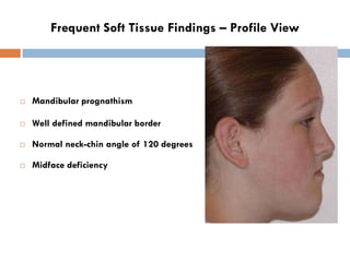 Frequent Soft Tissue Findings – Profile View




   Mandibular prognathism

   Well defined mandibular border

   Norma...