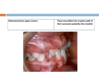 Retained primary upper incisors   These may deflect the eruption path of
                                  their successor...