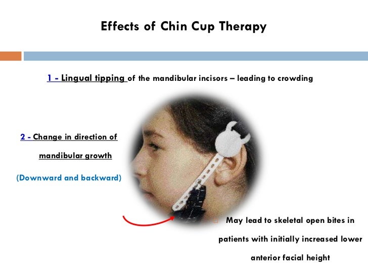 Class III Malocclusion Dr. Nabil AlZubair
