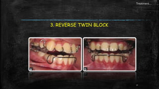 Class III malocclusion seminar | PPTX