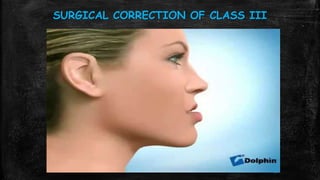 Class III malocclusion seminar | PPTX