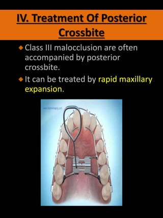 IV. Treatment Of Posterior
Crossbite
Class III malocclusion are often
accompanied by posterior
crossbite.
It can be treated by rapid maxillary
expansion.
 