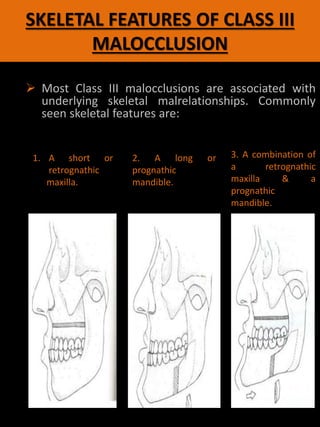 SKELETAL FEATURES OF CLASS III
MALOCCLUSION
 Most Class III malocclusions are associated with
underlying skeletal malrelationships. Commonly
seen skeletal features are:
1. A short or
retrognathic
maxilla.
2. A long or
prognathic
mandible.
3. A combination of
a retrognathic
maxilla & a
prognathic
mandible.
 