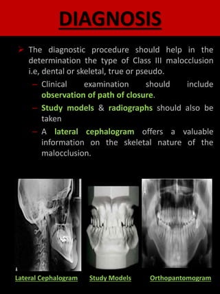 DIAGNOSIS
 The diagnostic procedure should help in the
determination the type of Class III malocclusion
i.e, dental or skeletal, true or pseudo.
– Clinical examination should include
observation of path of closure.
– Study models & radiographs should also be
taken
– A lateral cephalogram offers a valuable
information on the skeletal nature of the
malocclusion.
Lateral Cephalogram Study Models Orthopantomogram
 