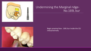 Undermining the Marginal ridge-
No.169L bur
Begin proximal box : 169L bur inside the CEJ
interproximally
 