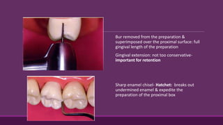 Bur removed from the preparation &
superimposed over the proximal surface: full
gingival length of the preparation
Gingival extension: not too conservative-
important for retention
Sharp enamel chisel- Hatchet: breaks out
undermined enamel & expedite the
preparation of the proximal box
 