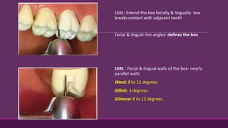 169L: Extend the box facially & lingually- box
breaks contact with adjacent tooth
Facial & lingual line angles: defines the box
169L : Facial & lingual walls of the box- nearly
parallel walls
Ward: 3 to 12 degrees
Gillett: 3 degrees
Gilmore: 8 to 12 degrees
 