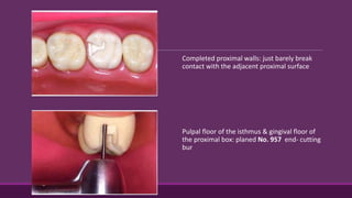 Completed proximal walls: just barely break
contact with the adjacent proximal surface
Pulpal floor of the isthmus & gingival floor of
the proximal box: planed No. 957 end- cutting
bur
 