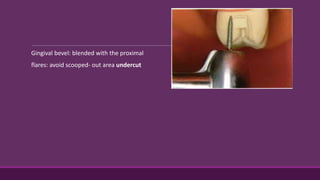 Gingival bevel: blended with the proximal
flares: avoid scooped- out area undercut
 