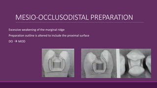 MESIO-OCCLUSODISTAL PREPARATION
Excessive weakening of the marginal ridge
Preparation outline is altered to include the proximal surface
DO  MOD
 