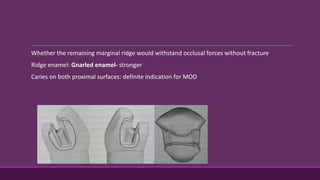 Whether the remaining marginal ridge would withstand occlusal forces without fracture
Ridge enamel: Gnarled enamel- stronger
Caries on both proximal surfaces: definite indication for MOD
 