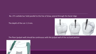 No. 271 carbide bur held parallel to the line of draw, extend through the facial ridge
The depth of the cut: 1.5 mm.
The floor (pulpal wall) should be continuous with the pulpal wall of the occlusal portion
 