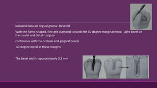 Included facial or lingual groove- beveled
With the flame-shaped, fine-grit diamond- provide for 30-degree marginal metal Light bevel on
the mesial and distal margins-
continuous with the occlusal and gingival bevels
40-degree metal at these margins
The bevel width- approximately 0.5 mm
 