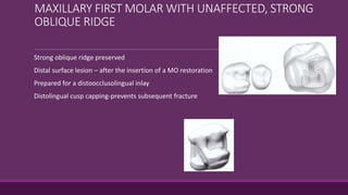 MAXILLARY FIRST MOLAR WITH UNAFFECTED, STRONG
OBLIQUE RIDGE
Strong oblique ridge preserved
Distal surface lesion – after the insertion of a MO restoration
Prepared for a distoocclusolingual inlay
Distolingual cusp capping-prevents subsequent fracture
 