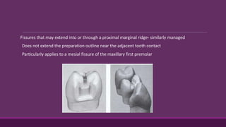 Fissures that may extend into or through a proximal marginal ridge- similarly managed
Does not extend the preparation outline near the adjacent tooth contact
Particularly applies to a mesial fissure of the maxillary first premolar
 