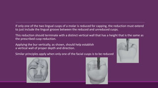 If only one of the two lingual cusps of a molar is reduced for capping, the reduction must extend
to just include the lingual groove between the reduced and unreduced cusps.
This reduction should terminate with a distinct vertical wall that has a height that is the same as
the prescribed cusp reduction.
Applying the bur vertically, as shown, should help establish
a vertical wall of proper depth and direction.
Similar principles apply when only one of the facial cusps is to be reduced
 