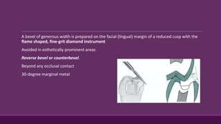 A bevel of generous width is prepared on the facial (lingual) margin of a reduced cusp with the
flame shaped, fine-grit diamond instrument
Avoided in esthetically prominent areas
Reverse bevel or counterbevel.
Beyond any occlusal contact
30-degree marginal metal
 