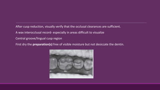 After cusp reduction, visually verify that the occlusal clearances are sufficient.
A wax interocclusal record- especially in areas difficult to visualize
Central groove/lingual cusp region
First dry the preparation(s) free of visible moisture but not desiccate the dentin.
 